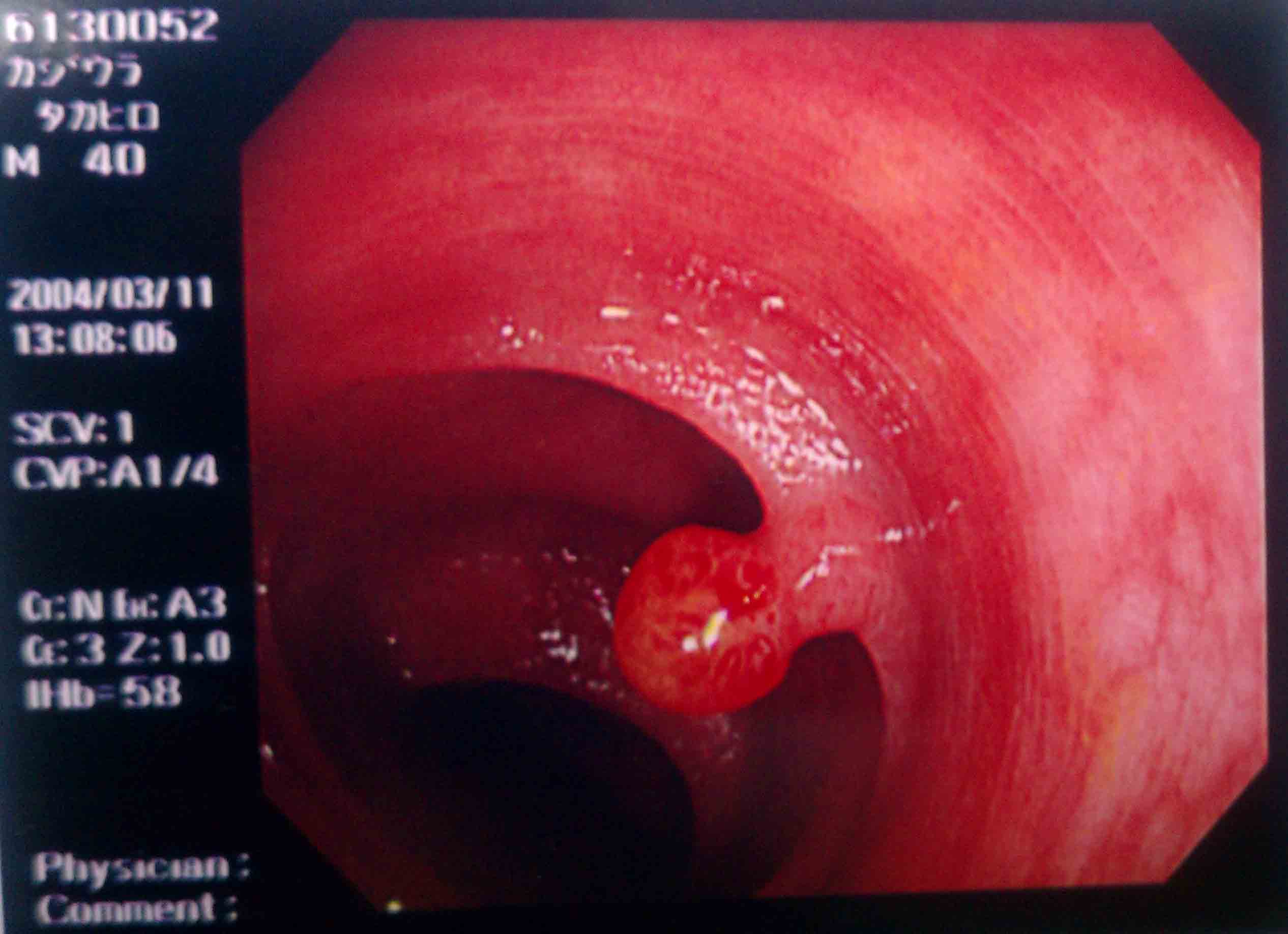 polyp